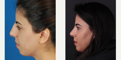 Chin Implant before and after photo