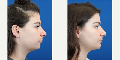 Chin Implant before and after photo