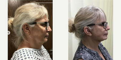 Facelift before and after photo