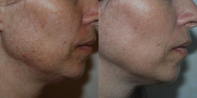 Laser Resurfacing before and after photo