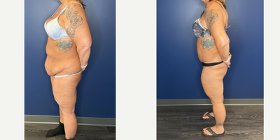 Arm Lift before and after photo