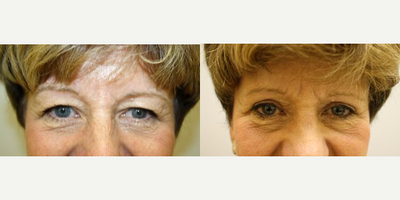 Eyelid Surgery before and after photo
