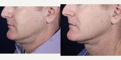 Kybella before and after photo