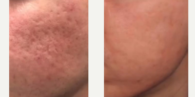 AviClear before and after photo
