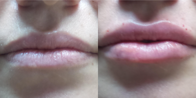 Lip Fillers before and after photo