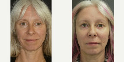 Mini Facelift before and after photo