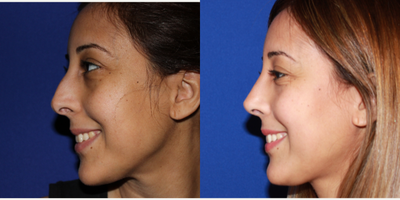 Rhinoplasty before and after photo