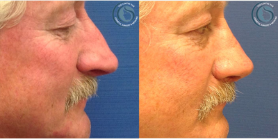 Rhinoplasty before and after photo