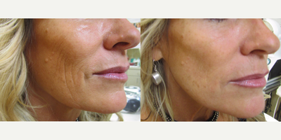 Volbella before and after photo