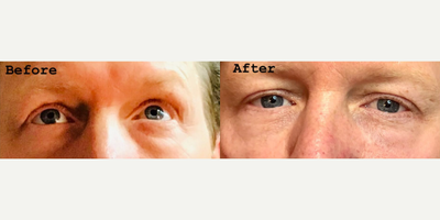Dermal Fillers before and after photo