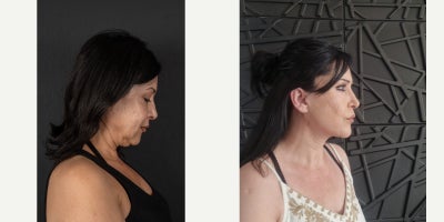 Facelift before and after photo