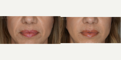 Juvederm before and after photo