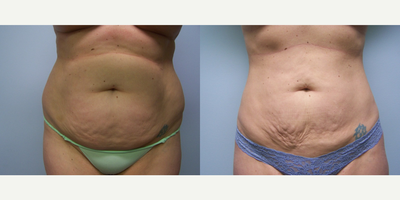 Liposuction before and after photo