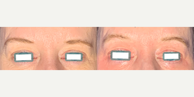 Morpheus8 before and after photo