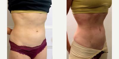 Abdominal Etching before and after photo