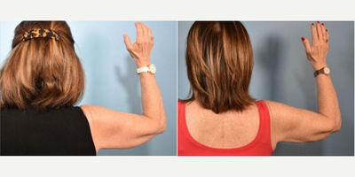 CoolSculpting before and after photo
