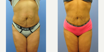 Brazilian Butt Lift before and after photo