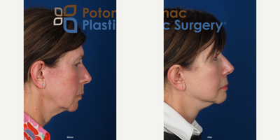 Chin Implant before and after photo