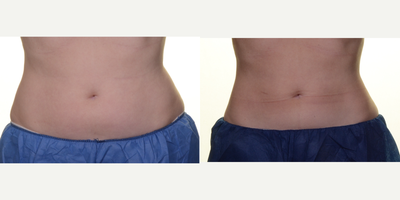 CoolSculpting before and after photo