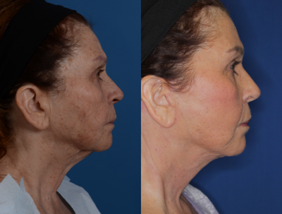 Facelift before and after photo