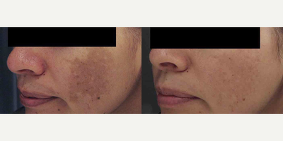Laser Resurfacing before and after photo