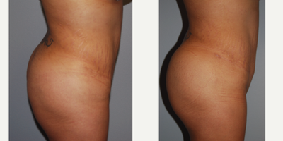 Brazilian Butt Lift before and after photo