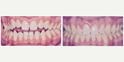 Clear Braces before and after photo