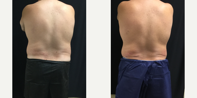 CoolSculpting before and after photo