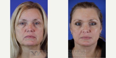 Facial Fat Transfer before and after photo