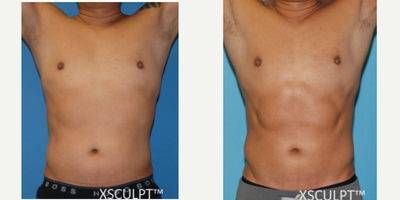Smart Lipo before and after photo