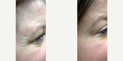 Botox before and after photo