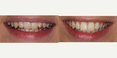 Clear Braces before and after photo