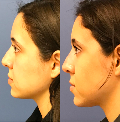 Dermal Fillers before and after photo