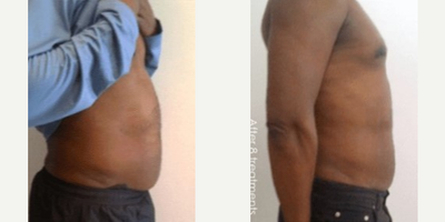 Laser Liposuction before and after photo