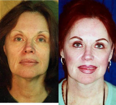 Lower Facelift before and after photo
