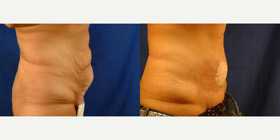 Tummy Tuck before and after photo