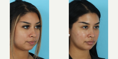 Buccal Fat Removal before and after photo