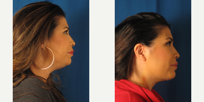 Chin Liposuction before and after photo