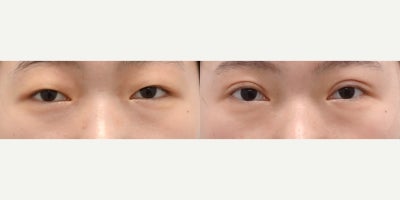 Double Eyelid Surgery before and after photo