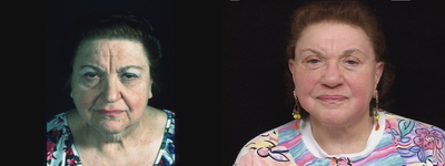 Facelift before and after photo