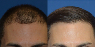 Hair Transplant before and after photo