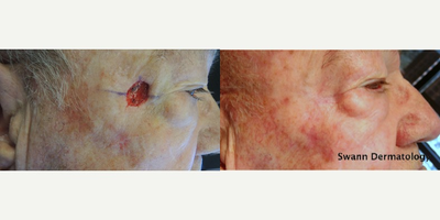 Mohs Surgery before and after photo