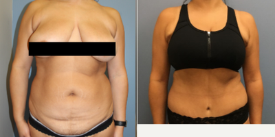 Tummy Tuck before and after photo