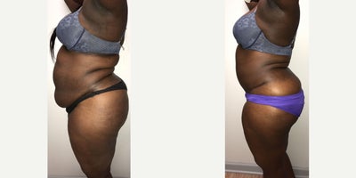Tummy Tuck before and after photo
