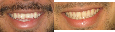 Braces before and after photo