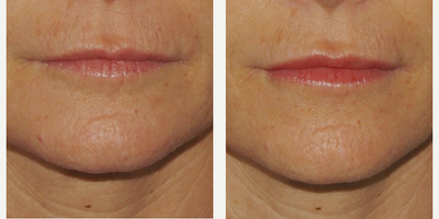 Dermal Fillers before and after photo