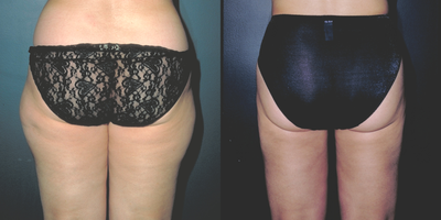 Liposuction before and after photo