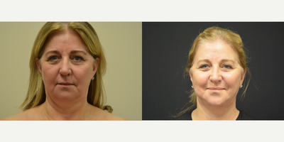 Lower Facelift before and after photo
