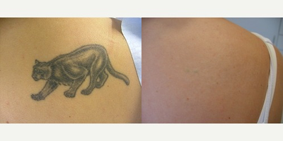 Tattoo Removal before and after photo