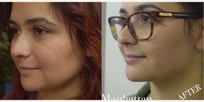 Chin Liposuction before and after photo